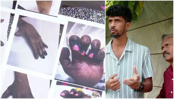 കൊഴുപ്പ് നീക്കല്‍ ശസ്ത്രക്രിയ; 